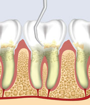 Gum Scaling